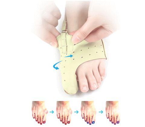 Bunion Corrector