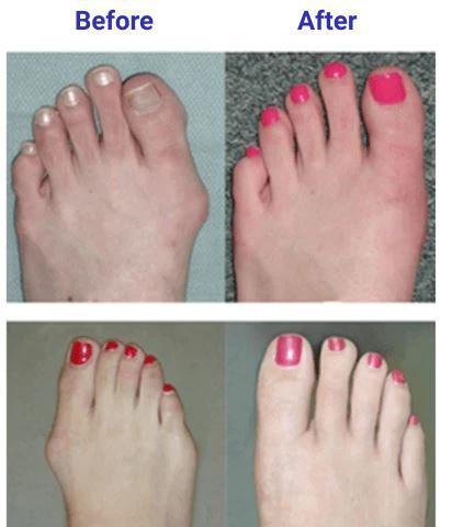 Bunion Corrector