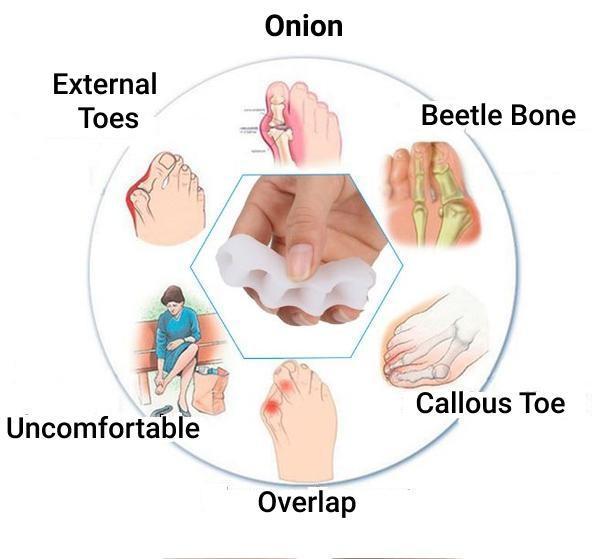 Orthopaedic Bunion Corrector